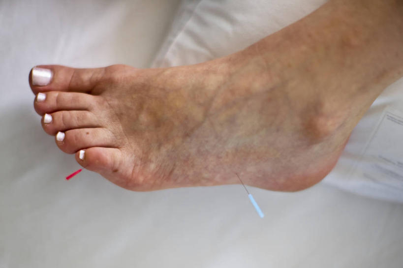 西方人,成年人,中年人,关节,踝,一个人,横图,特写,欧洲,美国,欧洲人,仅一个女性,仅一个人,仅一个中年女性,怀孕,摄影,部分,北美,北美洲,美洲,针灸,足,佛罗里达,佛罗里达州,佛州,阳光州,迈阿密海滩,针灸针,北亚美利加洲,亚美利加洲,女人,女性,中年女性,白种人,彩图,美利坚合众国